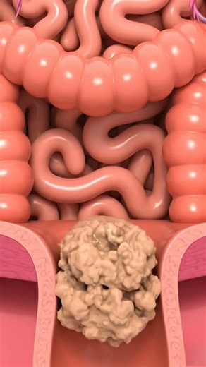 3D Animation of Constipation Explained | Gut Health & Digestive System Visualization