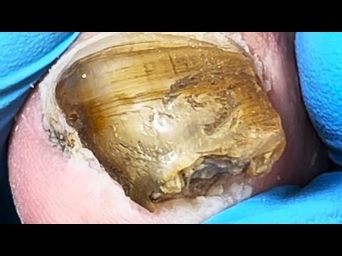 Thick Fungus Covering The Toenails That Slowly Separates