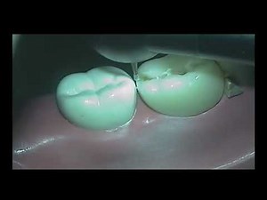 Class II on Acadental Caries tooth