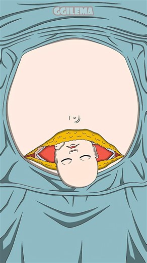제왕절개 과정 / How a C-Section Works(Animated)