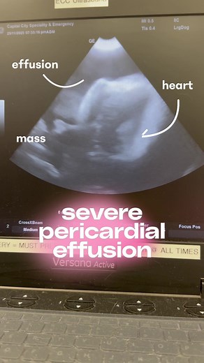 In this video, you’re seeing fluid building up around a dog’s heart — a condition called pericardial effusion. That fluid fills the pericardial sac and physically compresses the heart, making it almost impossible for it to pump blood the way it needs to. This can quickly lead to collapse or even sudden death if not treated urgently ⚠️ 🐶 What this can look like at home:�• Trouble breathing or breathing faster than normal 🫁�• Slowing down, weakness, or sudden collapse�• Pale gums ⚪�• A swollen b