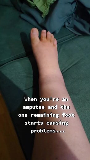 fairly certain it's not CRPS but will talk about this more soon and hopefully have an update after speaking to a doctor tomorrow - I've been trying to pretend nothing is happening for a couple of weeks now but it's time to get it sorted out! #disabled #disabledtiktok #disability #disabilitytiktok #amputee #amputeelife #amputeetiktok #crps #rsd #chronicillness