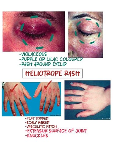 Heliotrope Rash vs Gottron Papules/Sign -Dermatomyositis | Rheumatology