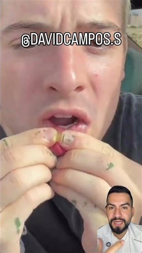 MUCOCELE