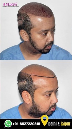 Watch 6000 Grafts Transform This Bald Head #HairTransplant #Transformation
