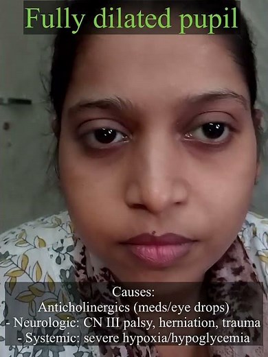 Fully dilated pupil