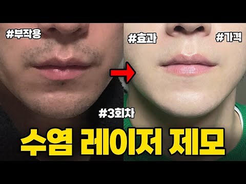 수염 레이저 제모 후기 l 부작용? 효과? 병원, 가격, 기계, 2주간 변화과정 l 남자 수염 레이저 제모 3회차 내돈내산 솔직 후기
