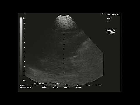 Female heart, ultrasound view, heartbeat sound