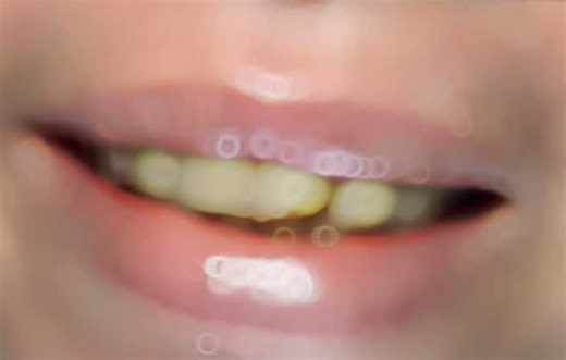 غير ابتسامتك من غير ما تبان إنها تركيبات 😍 عندنا في سمارت سمايل التركيبات مش مجرد سن جديد… دي ابتسامة متصممة على ملامحك ✨ لو عندك تركيبة قديمة لونها مختلف أو شكلها مش مريحك نقدر نبدلها بتركيبة جديدة شكل طبيعي 👌 وتناسق يغير ابتسامتك تمامًا 😁 📍 العنوان: الجلاء أمام البوسطة – برج أولاد الشال – الدور الثاني 📞 احجز دلوقتي: 01022564300 📲 واتساب أو رسائل إنستجرام احجز الآن #سمارت_سمايل #تركيبات_أسنان #تجميل_الأسنان #SmileMakeover #DentalCrowns #SmartSmile #NaturalSmile #Zirconia #Emax #porcelainc