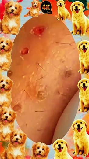 Blackheads Removal | Acne Treatment and Very Satisfying Satisfying Pimple pop #blackheads