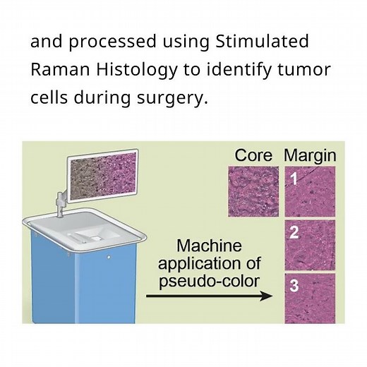 Detection of glioma infiltration at the tumor margin using Stimulated Raman Histology