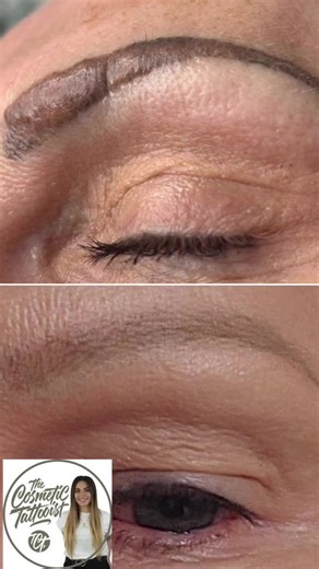 Xtract® ink removal technology is the only removal system that contains immune modulators to remove allergic reactions to Ink. This client had a allegiv reaction that formed granulomas over a period of time. Xtract successfully removed granulomas and restores the skins integrity. Photo and removal credit goes to the cosmetic tattooist @Leah Jane Raja # inkallergy #granuloma #inkremoval #pmuremoval #holistichealing #askdrben #patent #integrity #innovation @Osmosis Beauty @Erika Educates