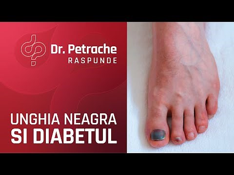 AM O UNGHIE NEAGRA LA PICIOR, CE SA FAC?
