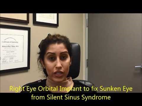 Right Eye Orbital Implant for Sunken Eye (enophthalmos) - Silent Sinus Syndrome Treatment