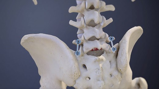 Understanding L5-S1 Spinal Fusion Animation