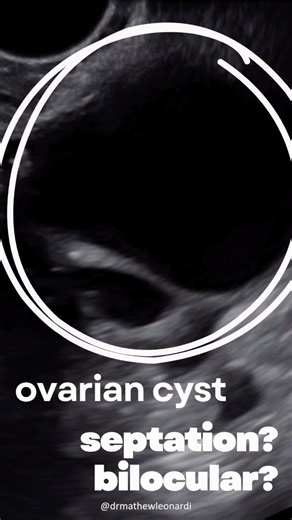 Dr Mathew Leonardi on Instagram: "Too many cysts get mislabeled because people confuse incomplete septations with new locules. In IOTA terminology, a unilocular cyst has a single cavity with no complete septa. If you see a thin, incomplete septation that doesn’t traverse wall to wall — it’s still unilocular. You can note the partial septation, but it doesn’t create another locule. A bilocular cyst only exists when a complete septum divides the cavity into two distinct, non-communicating locules.
