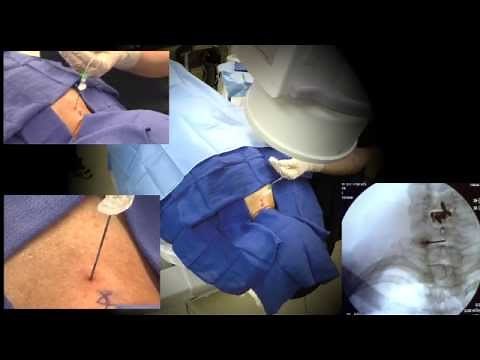 WATCH a Cervical Epidural Steroid Injection Demonstration - LIVE!