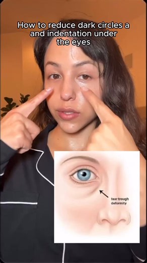 Elsa on Instagram: "This routine will help brighten your under eyes and also decrease any deep indentations 🤍 in this routine I use the @easydew_usa serum that helps us produce more EGF, increasing our skins elasticity and the AHA in the product will help brighten your under eyes as well! #skincare #makeup #kbeauty #egf #easydew #darkspots"
