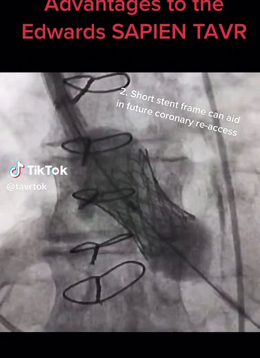 Here is an expample of a Balloon Expandable TAVR made by Edwards Lifesciences! This device is implanted with the help of a balloon inside of the TAVR, hence where it gets its name! Listed are some of the advantages of this type of valve compared to other TAVR valves used in the United States #TAVRTok #cardiology #interventionalcardiology #tavr #medicine #doctor #doctorsoftiktok #stemi #nursesoftiktok #nurse