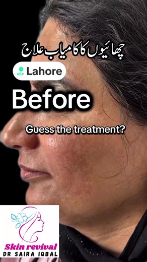 Understanding Melasma and Its Treatment Options