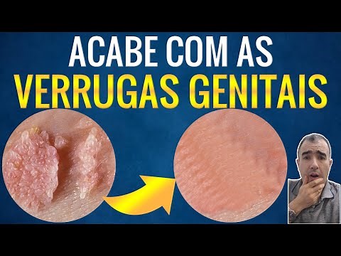 How to remove and destroy genital warts caused by HPV?