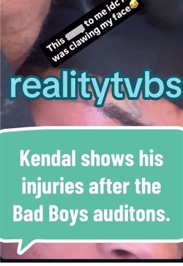Kendal shows his injuries after the auditions. #realitytvbs #nowthatstv #nttv #zeusnetwork #zeusnetworkbadboys