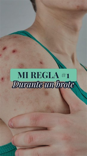 PSORIASIS: The 3 Things I Never Do When I Have a Flare-Up