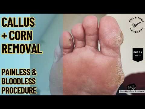 Corn And Callus Removal - Safe / Bloodless / Painless #cornremoval #asmr