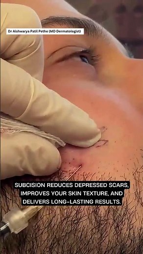 Subcision Treatment for Acne Scars | Dr. Aishwarya Patil Pethe, Dermatologist Pune