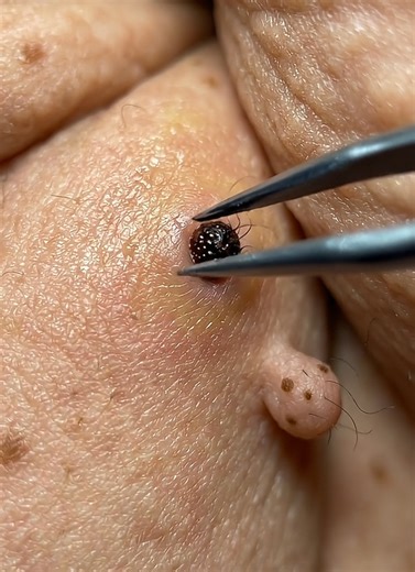 Ultimate Blackhead Removal Techniques