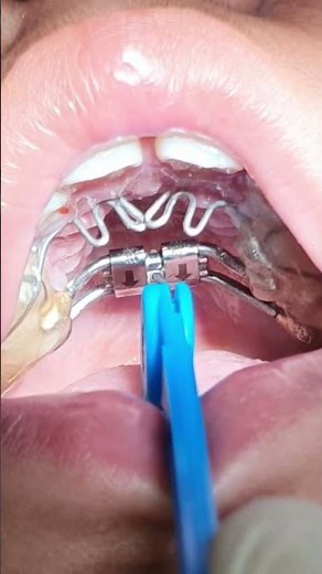 How to activate Expander in the mouth