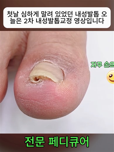 내성발톱 2차 교정: 통증 완화 및 관리 방법