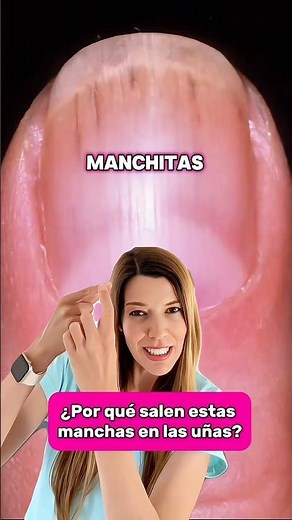 MANCHAS EN LAS UÑAS: CAUSAS Y SOLUCIÓN. Dermatóloga explica 👉