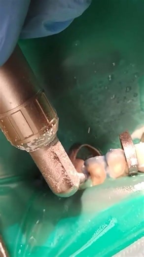 Sandblasting 22-23 teeth.#abrasiveblastingtooth