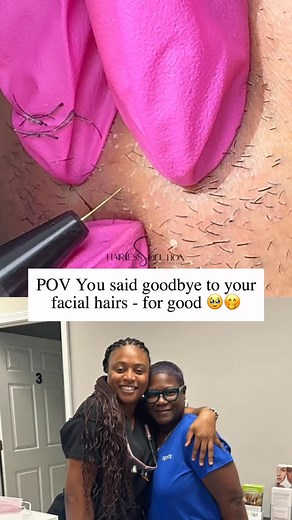 During the procedure, a fine probe is inserted into the hair follicle, and a small electrical current is delivered to the blood supply. This current destroys the follicle’s ability to produce new hair, leading to permanent hair removal over time. Click link in my bio to book / visit our website www.hairlesssolution.com ✅Follow @hairless_solution @hairless_solution #pcos #reels #laserhairremoval #fyp #esthetics #explorepage #hormonalacne #viralreels #foryou #electrolysisatlanta #electrolysis #hai