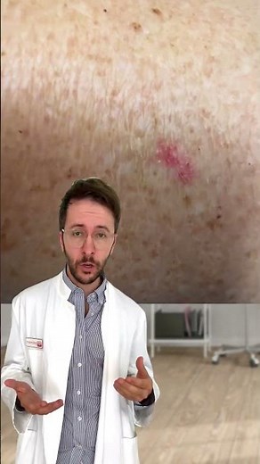 Dermatologe erklärt: So sieht weißer Hautkrebs aus! | DERMAFY #shorts