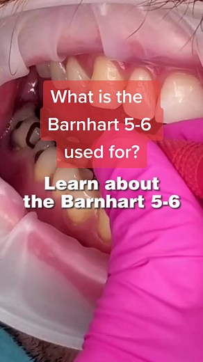 What is the Barnhart 5/6 used for? Watch & save this video to learn more! #younginnovations #americaneagleinstruments #barnhart5-6 #sharpenfreetechnology #xpsharpenfree#dentallife #dentalinstruments #madeintheusa #sharpenfree #staysharp #dentalhygiene #rdh #dentalhygienist #dentalhygienestudent apist #hygienist #dentalhygienestudent #dentalhygieneschool #futurerdh #futuredentalhygienist