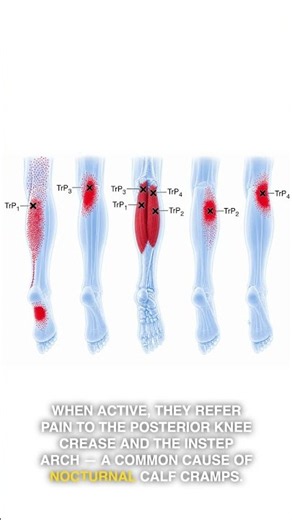 Gastrocnemius Trigger Points