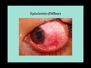 Scleritis and Episcleritis CRASH! USMLE Step 2 and 3