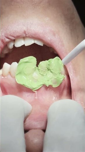 Zirconia crown to protect root canal treated upper central tooth 🦷 #dentist
