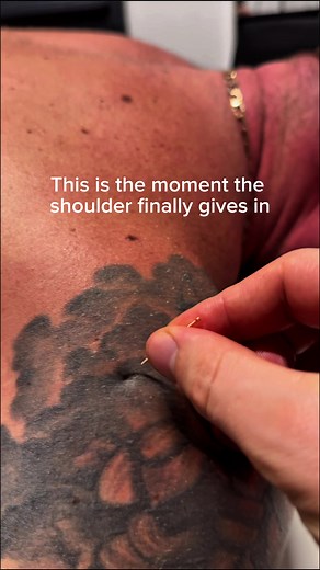Understanding Shoulder Twitching and Dry Needling Techniques