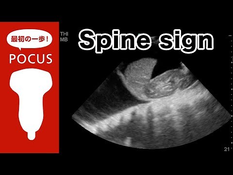 spine sign スパインサイン【POCUS・肺超音波】