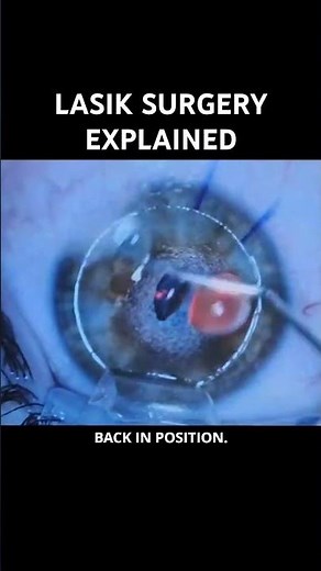 LASIK surgery explained
