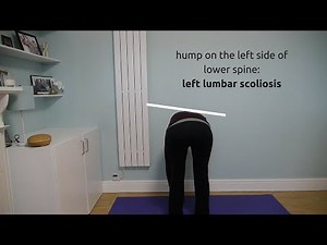 Adams Forward Bend Test