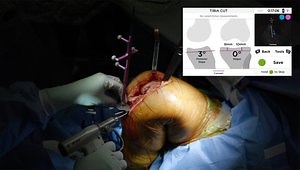 Primary Total Knee Arthroplasty Using Imageless Computer-Assisted Navigation