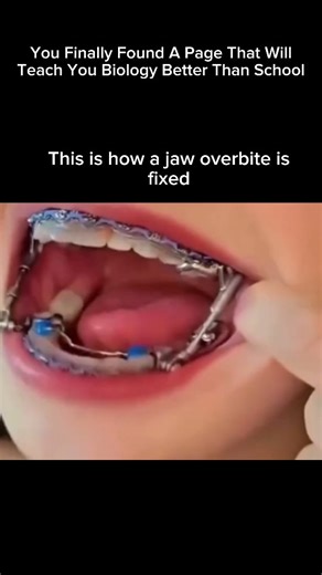 Explaining Biology on Instagram: "How a Jaw Overbite Is Fixed 🦷✨ An overbite happens when the upper teeth/jaw overlap too much over the lower teeth. Treatment depends on age and severity: 🔹 Braces or Clear Aligners Gradually move teeth into proper alignment. ✔️ Best for mild–moderate overbites 🔹 Jaw Growth Appliances (Kids/Teens) Guide jaw growth while the bones are still developing. ✔️ Early treatment = easier correction 🔹 Elastics (Rubber Bands) Used with braces to train the jaws into the 