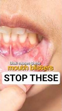 1 Simple Remedy for Painful Mouth Ulcers