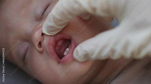 doctor dentist hands fingers in white gloves check sleeping caucasian baby infant first upper and low milk teeth eruption. kid child teething in swollen gums dentition in mouth