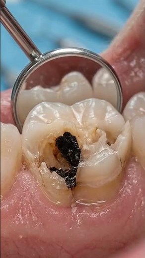 Fixing A Broken Tooth With A Crown – Cracked Or Chipped Tooth #cracked