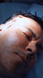 👀 Men are loving their PET Lift results! This patient achieved a more youthful, refreshed look with a procedure designed for anyone looking to enhance their appearance naturally. ✨ Ready to see what PET Lift can do for you? Financing options available! 📅 Book your free consultation today! Call 305-446-7277 | CG Cosmetic Surgery